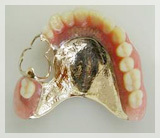 貴金属床義歯