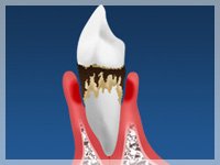 歯周病を治して生涯にわたって自分の歯を使う